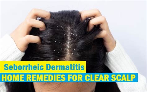 8 Effective Home Remedies For Seborrheic Dermatitis To Get Clear Scalp - Tips and Beauty