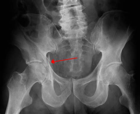 Pelvic Fracture