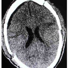 NCCT head (Postoperative) | Download Scientific Diagram