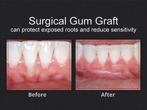 Canine Gum Graft Before And After