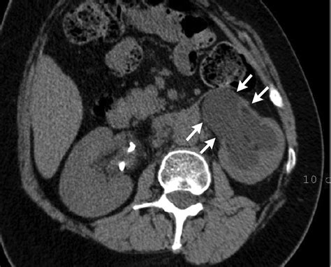 Retroperitoneal fibrosis | CMAJ