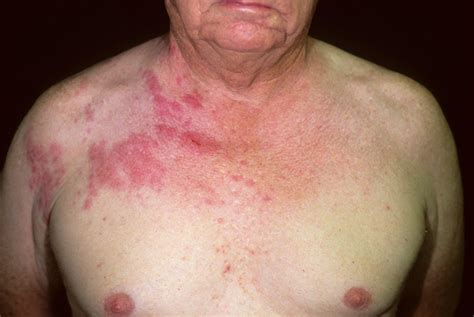 Shingles - Causes, Symptoms, Home Remedies, Treatment