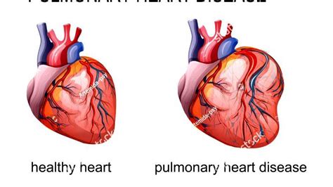 Pulmonary heart disease