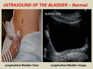 Normal Bladder Ultrasound