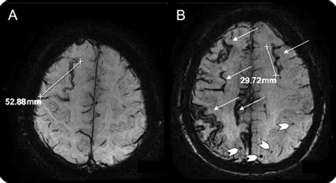 Alzheimer’s Disease Linked to Superficial Siderosis. What Does it Mean? | ALZFORUM