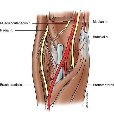 Relationship of the Median and Radial Nerves at the Elbow: Application to Avoiding Injury During ...