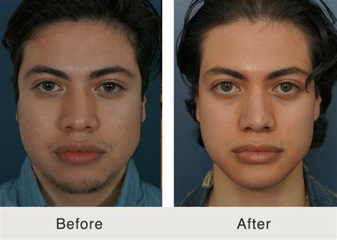 Nose Jobs and Rhinoplasties for Wide Noses - Carolina Facial Plastics