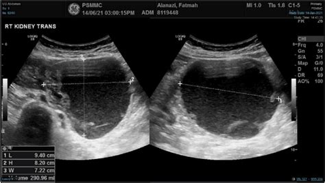 US showing a large right renal lower pole exophytic cystic lesion with... | Download Scientific ...