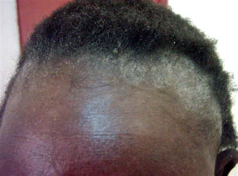 Know The Signs – 6 Scalp Problems We May Have To Deal With At Some Point In Our Life | Scalp ...