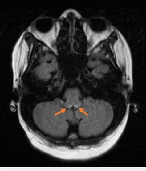 MRI brain non-contrast showing T2 signal abnormality in medial thalami ...