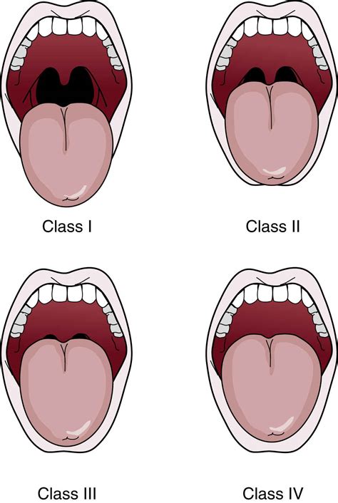 Assessment and Management of the Airway | Anesthesia Key