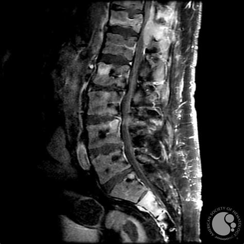 MRI myeloma