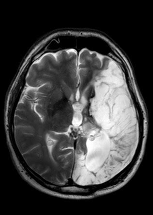 Encephalomalacia | Radiology Reference Article | Radiopaedia.org