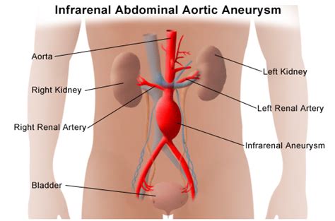 Aorta Abdominal