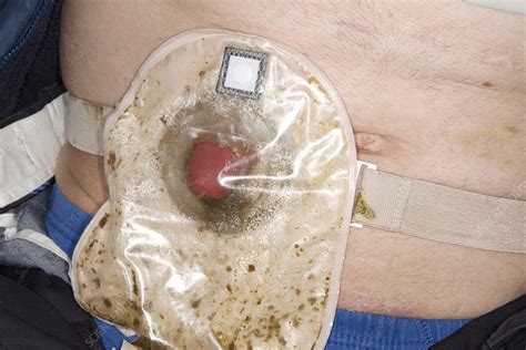 Ileostomy in rectal cancer - Stock Image - C023/4348 - Science Photo ...