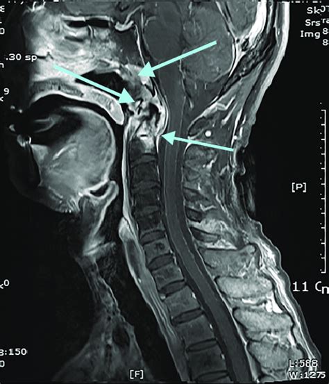 Craniocervical instability - MEpedia