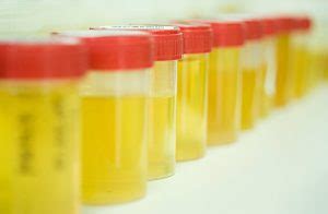 What causes oily urine and their risk factors?