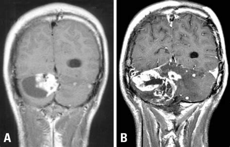 Tumor: Cerebellar Tumor