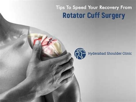 Tips To Speed Your Recovery From Rotator Cuff Surgery - shoulder clinic ...