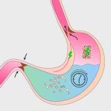 Mistakes in gastroparesis and how to avoid them | UEG - United European Gastroenterology