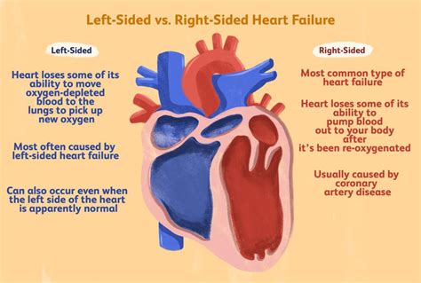 Left- vs. Right-Sided Heart Failure