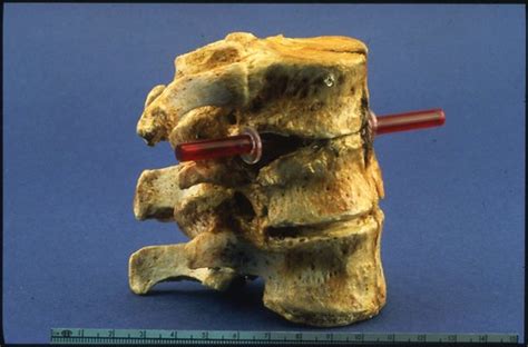 Thoracic and lumbar vertebrae of President Garfield (AFIP … | Flickr