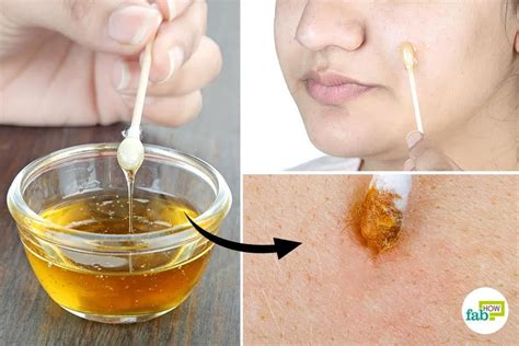 Honey for Acne: Top 10 Remedies and Masks | Fab How