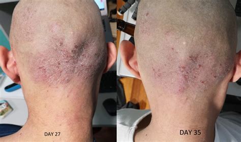 5 weeks: Day 35 photo update - Healing TSW