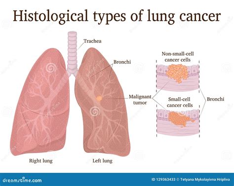 Illustration of Lung Cancer Types Stock Vector - Illustration of breath, neoplasm: 129363433