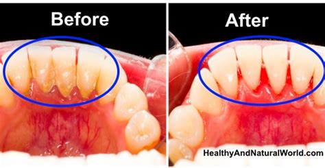 How to Remove Dental Plaque Naturally (Evidence Based)