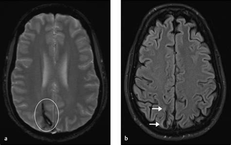 14 Developmental Venous Anomaly | Radiology Key