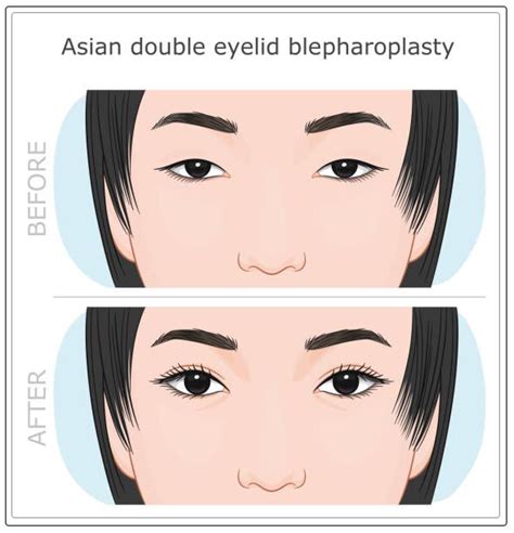 Double Eyelid Surgery: Procedure and Alternatives - AlQudrahMC