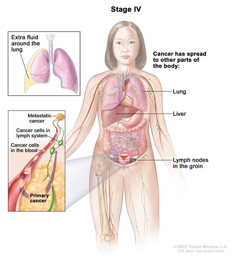 Ovarian Germ Cell Tumors Treatment (PDQ®)–Health Professional Version ...