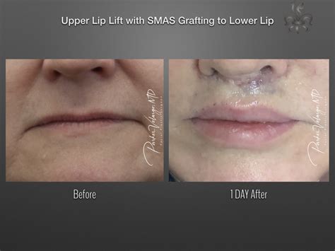 Lip Lift Case 4353 - New Orleans Premier Center for Aesthetics and Plastic Surgery