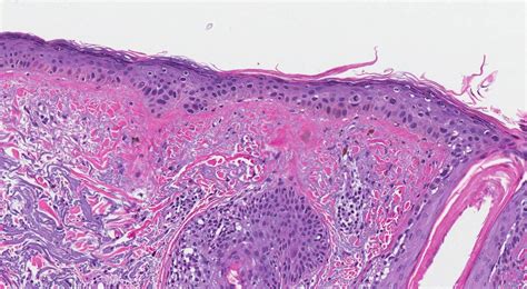 Actinic keratosis | Ottawa Atlas of Pathology