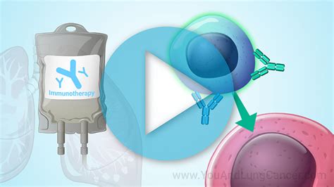 Slide Show - Immunotherapy Treatments for Non-small Cell Lung Cancer (NSCLC)