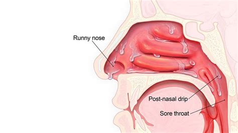 Symptoms and Potential Complications of Post-nasal Drip – Entirely Health