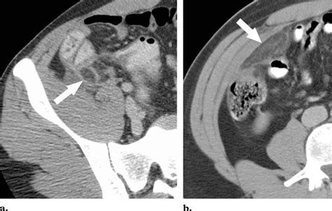 Acute epiploic appendagitis near the cecum. Axial contrast-enhanced CT... | Download Scientific ...