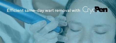 CryoPen: Using Cryotherapy for Wart removal | IV SITE