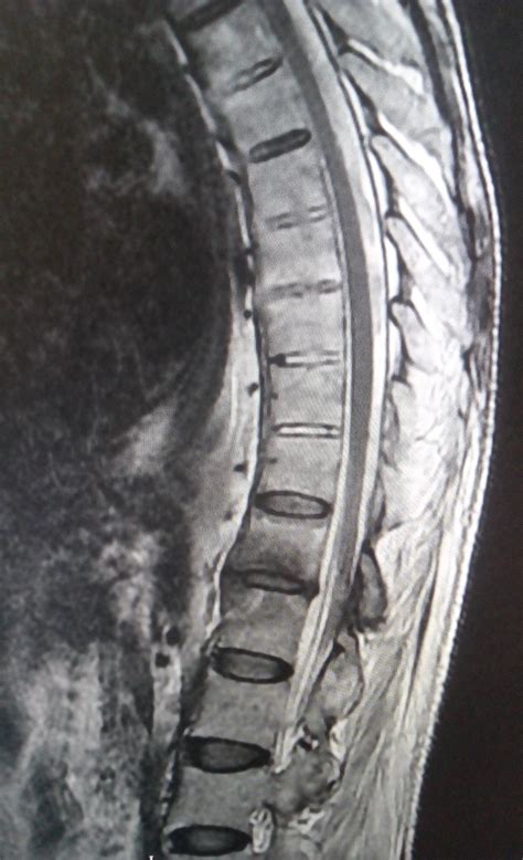 Ankylosing Spondylitis: MRI - Sumer's Radiology Blog