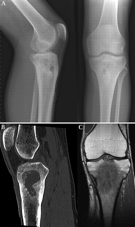 Brodie's abscess | Emergency Medicine Journal