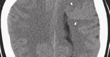 Schizencephaly-Mayo Radiology