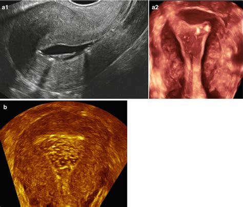 Endometrial Polyps | Radiology Key