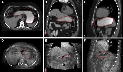 Cone Beam Radiation Therapy - The Best Picture Of Beam