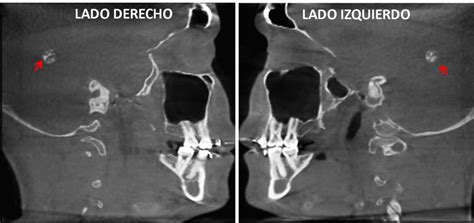 Calcificación de los Plexos Coroideos – Dento Metric | Radiología Dental, Oral y Maxilofacial