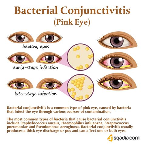 Bacterial Conjunctivitis | Bacterial pink eye, Pink eye antibiotics ...