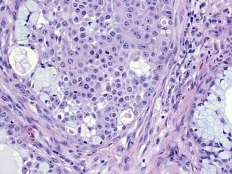 Mucoepidermoid Carcinoma Histology