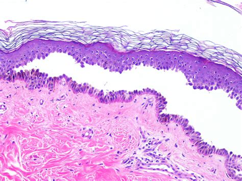 Pemphigus Vulgaris - A Dermatological Red Herring — Firstclass