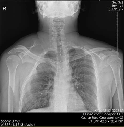 Sprengel Deformity - radRounds Radiology Network