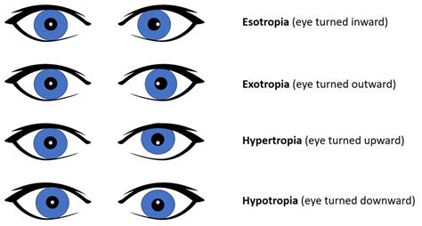 Prueba de Hirschberg, usos de la prueba de reflejo de luz corneal Hirschberg | Datakosine